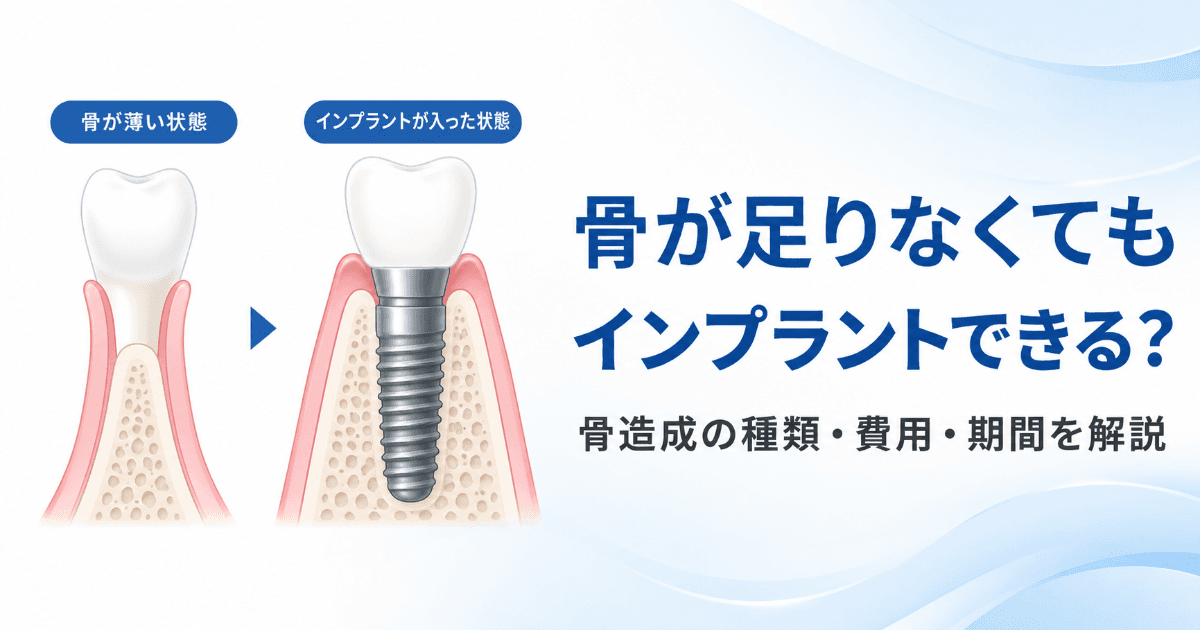 顎の骨が足りないとインプラントはできない?骨造成の種類・費用・期間を解説|コラムのアイキャッチ画像