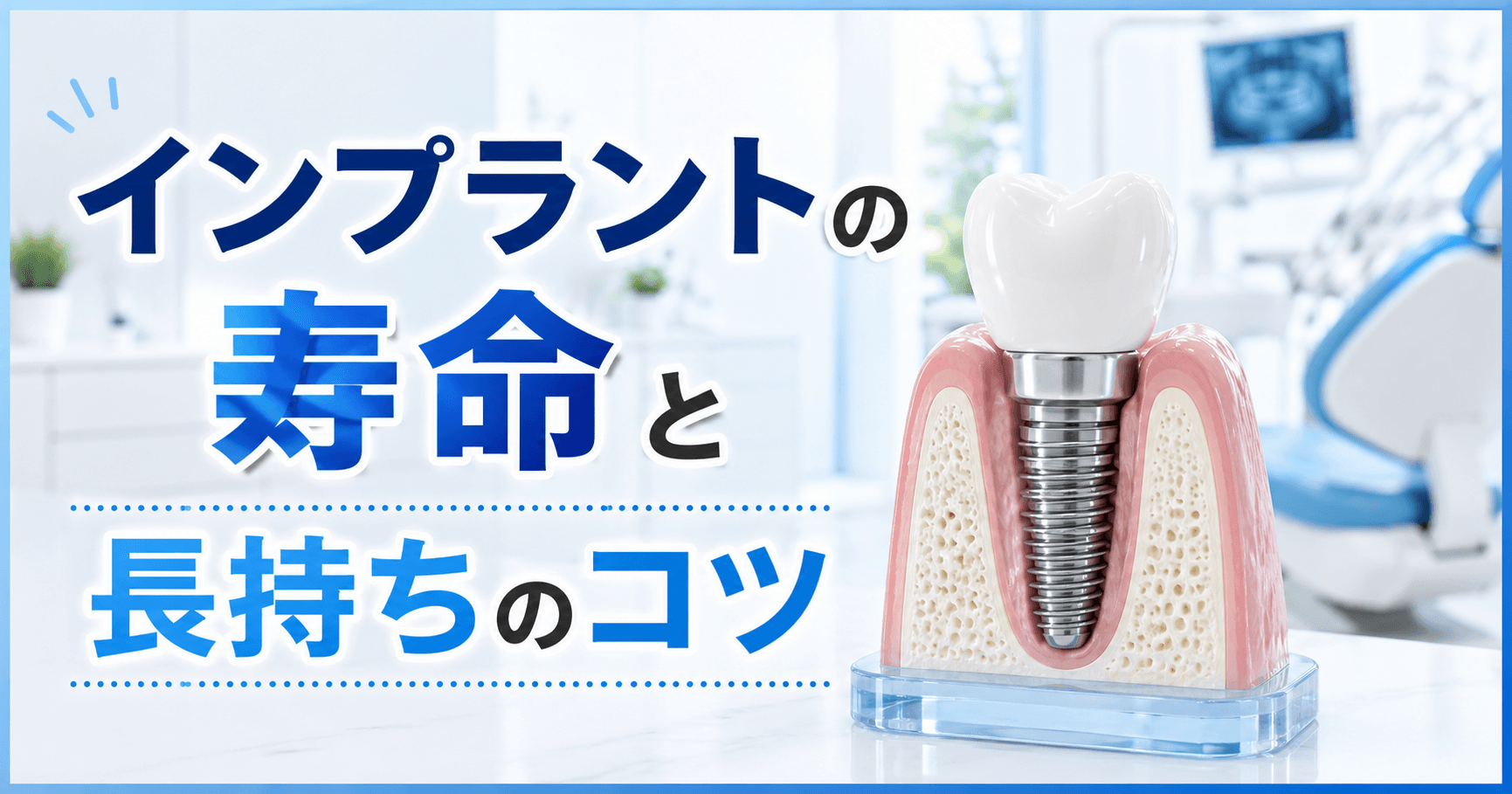 インプラントの寿命は何年?長持ちさせる5つのポイントと費用の目安|コラムのアイキャッチ画像